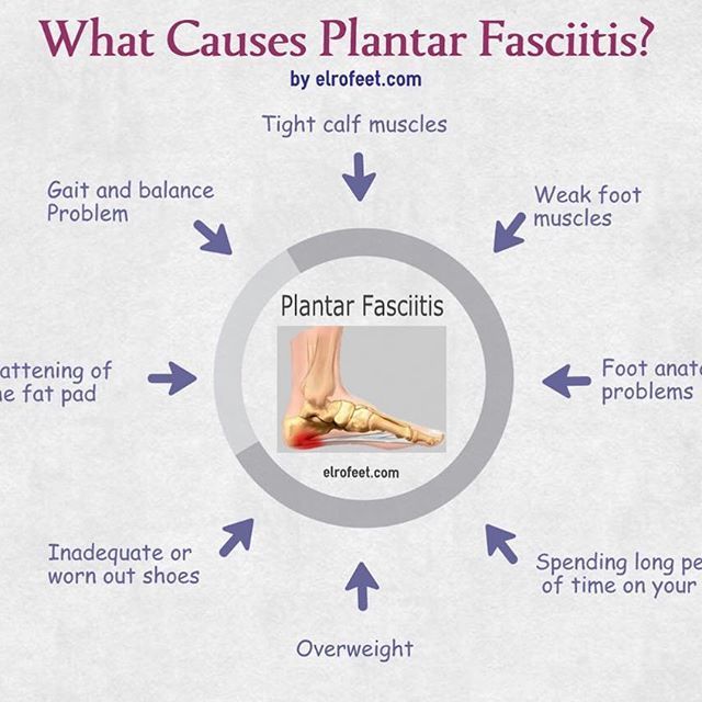 A spot on depiction of the causes for Plantar Fasciitis. Does any of ...