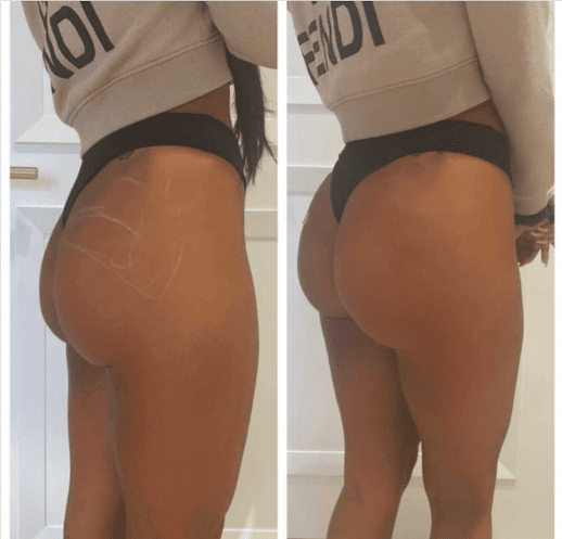 Brazilian Butt Lift Before &  After