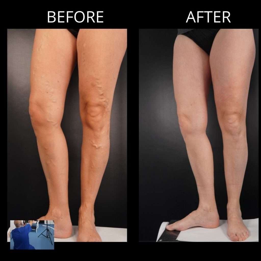 Can you remove varicose veins without surgery and without ...