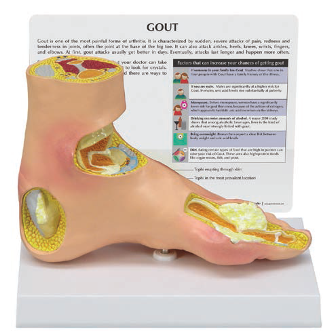 Gout Foot Model