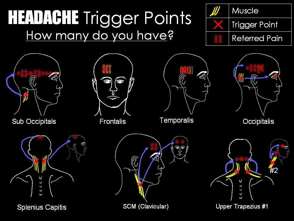 Headache trigger points