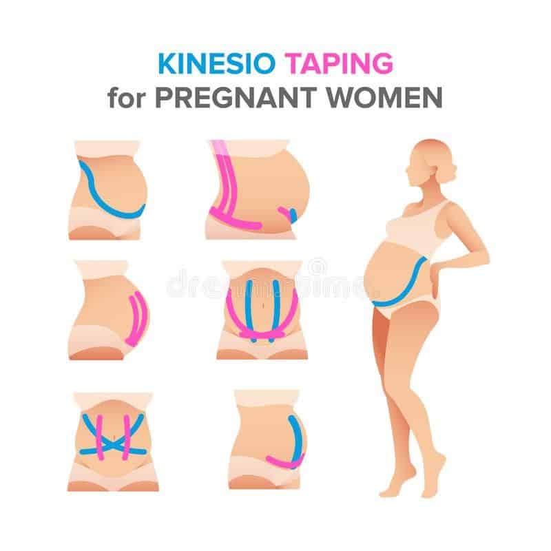Kinesio taping illustrations for pregnant women royalty free ...