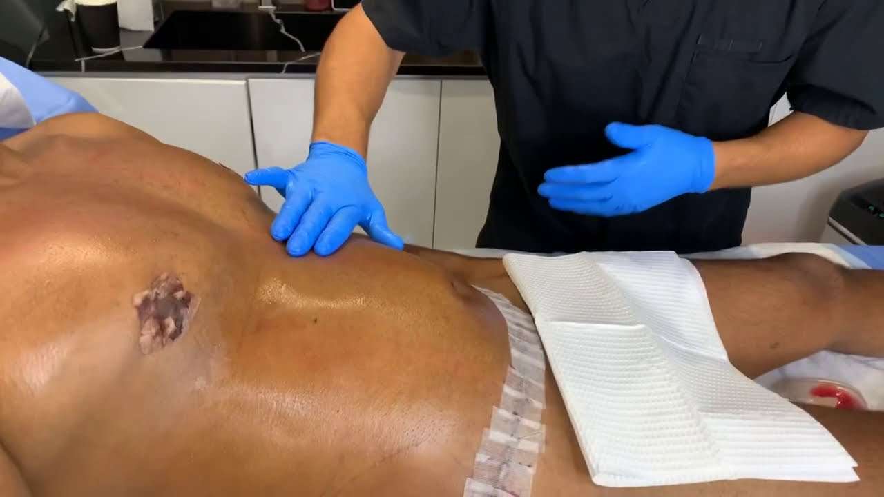 LYMPHATIC DRAINAGE MASSAGE AFTER LIPO TO REDUCE PAIN/SWELLING
