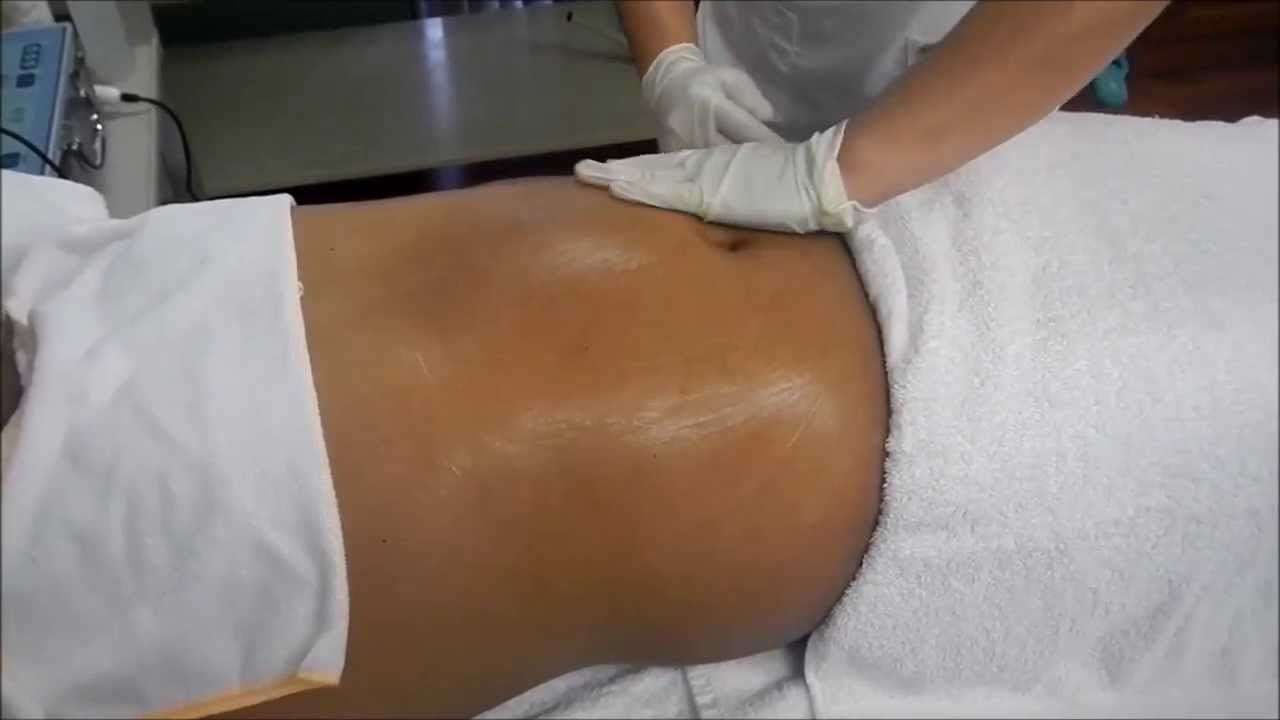 Lymphatic drainage massage after liposuction