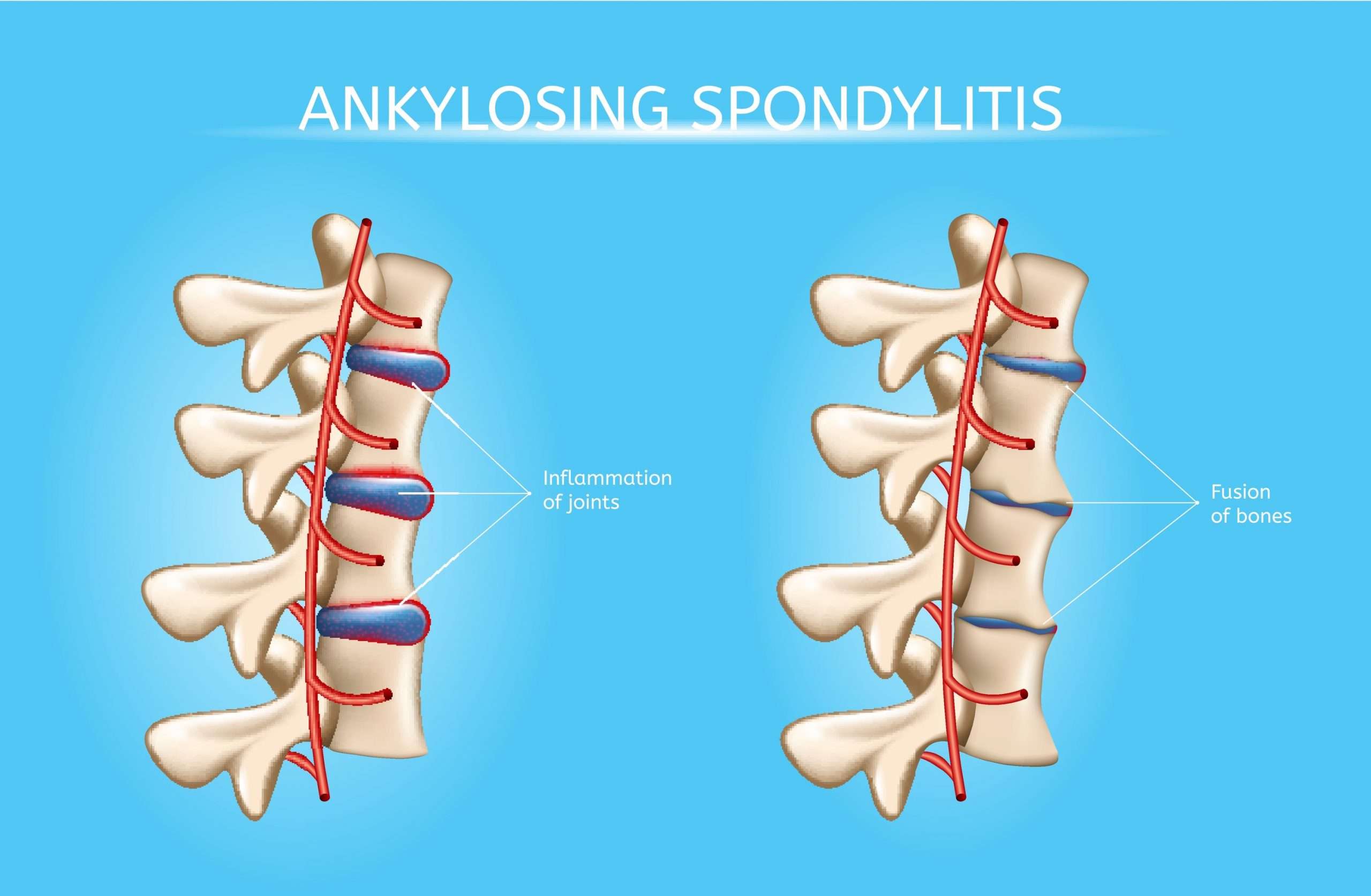Massage for Ankylosing Spondylitis (AS)