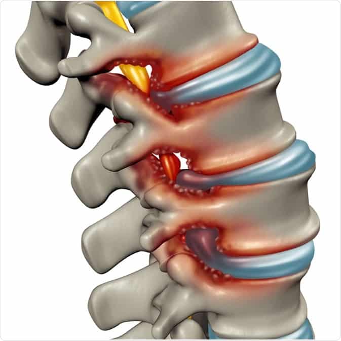 Spinal Stenosis : What is Spinal Stenosis