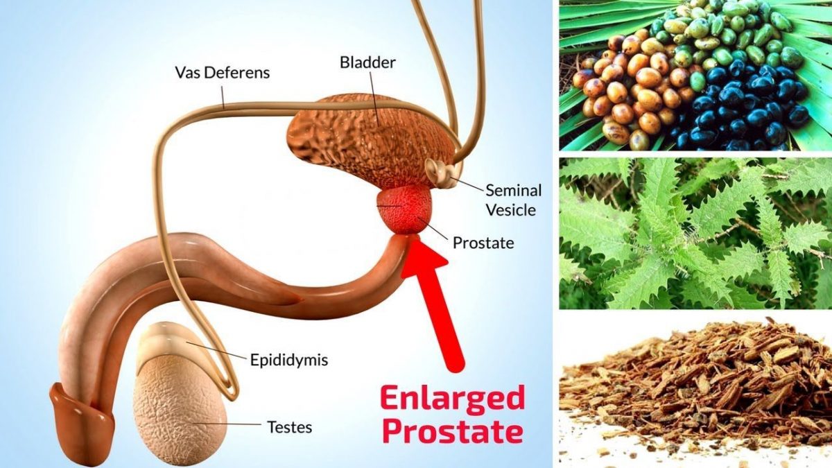 Top 5 Natural Home Remedies For Enlarged Prostate